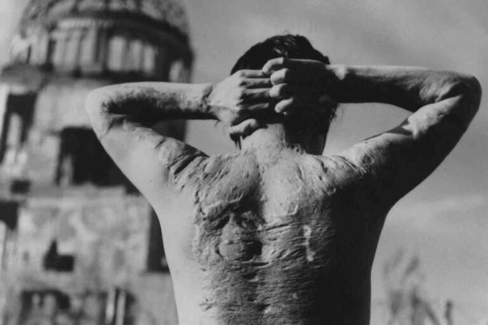 vittima della bomba atomica